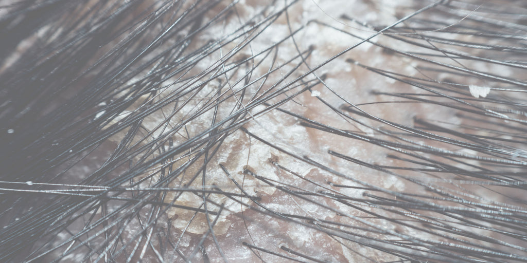 Dandruff vs Dry Scalp: Why You're Probably Treating the Wrong One