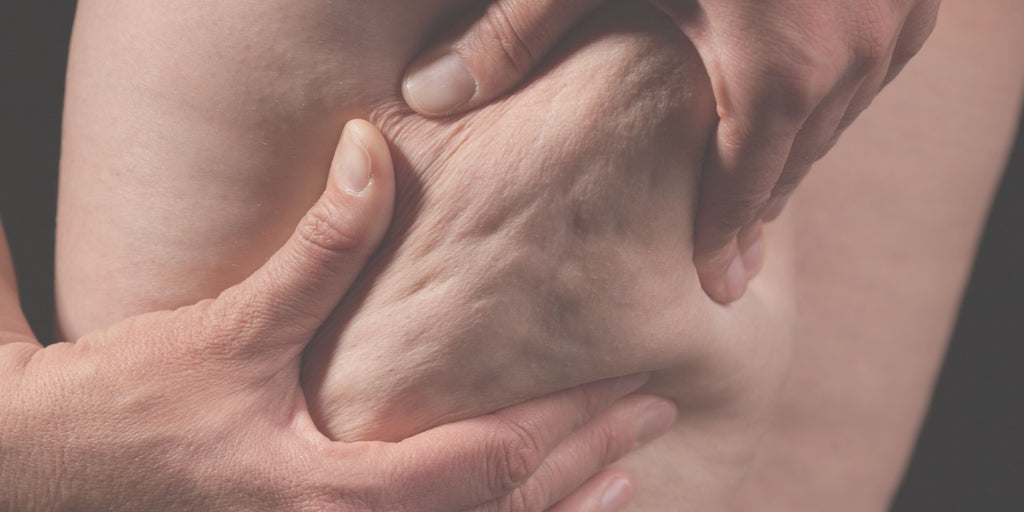 What Causes Cellulite (And What Every "Cure" Gets Wrong)