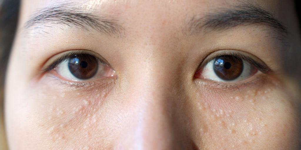 What Causes Milia (And How to Actually Get Rid of Them)