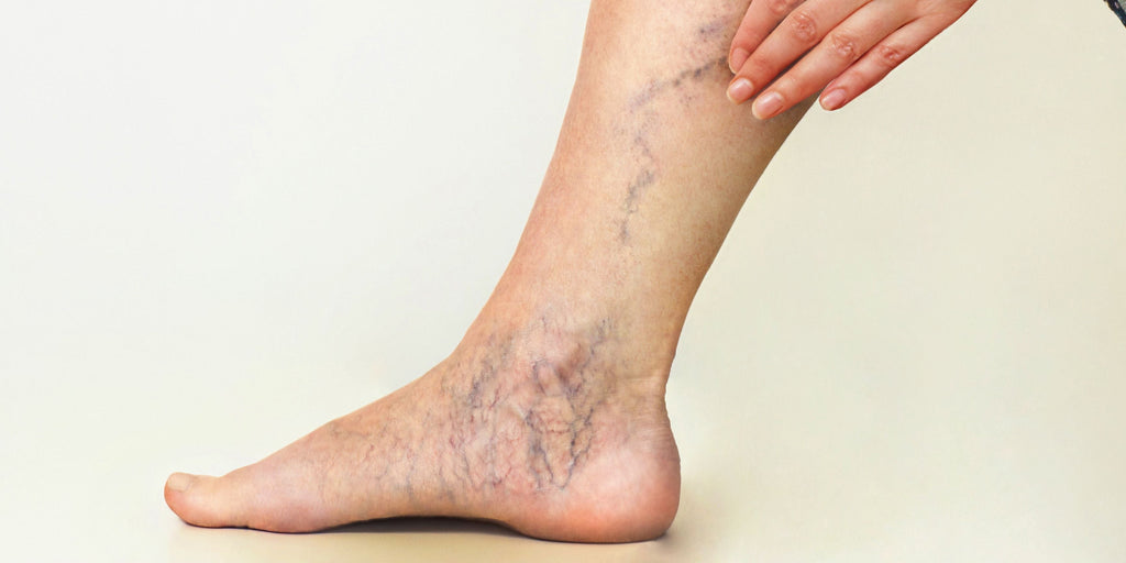 What Causes Varicose Veins (And Why No Cream Can Fix Them)