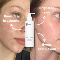 Close-up of a womans face with before-and-after results: the left shows breakouts, the right looks clear. Text highlights Banishes breakouts, Brightens skin, Evens complexion. Picture-Perfect Face (Super Boost) by Basic Maintenance bottle is centered.